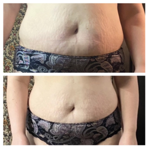 Видео урок - массажа живота для уменьшения объёмов