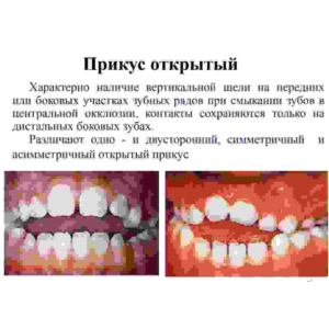 Варианты прикусов у человека