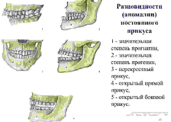 Bite options in humans
