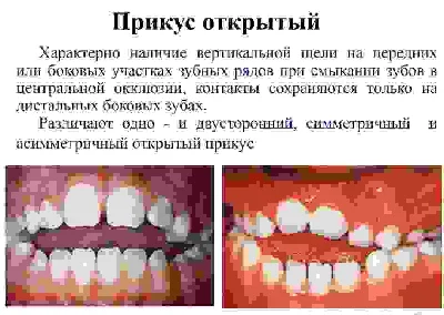 Bite options in humans