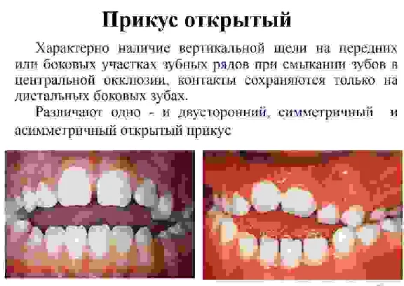 Bite options in humans