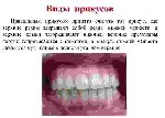 Варианты прикусов у человека