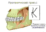 Варианты прикусов у человека