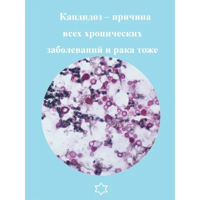 Кандидоз – причина всех хронических заболеваний и рака - irongamers.ru