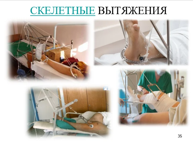 СЕСТРИНСКИЙ УХОД ЗА ПАЦИЕНТАМИ ПРИ СКЕЛЕТНОМ ВЫТЯЖЕНИИ