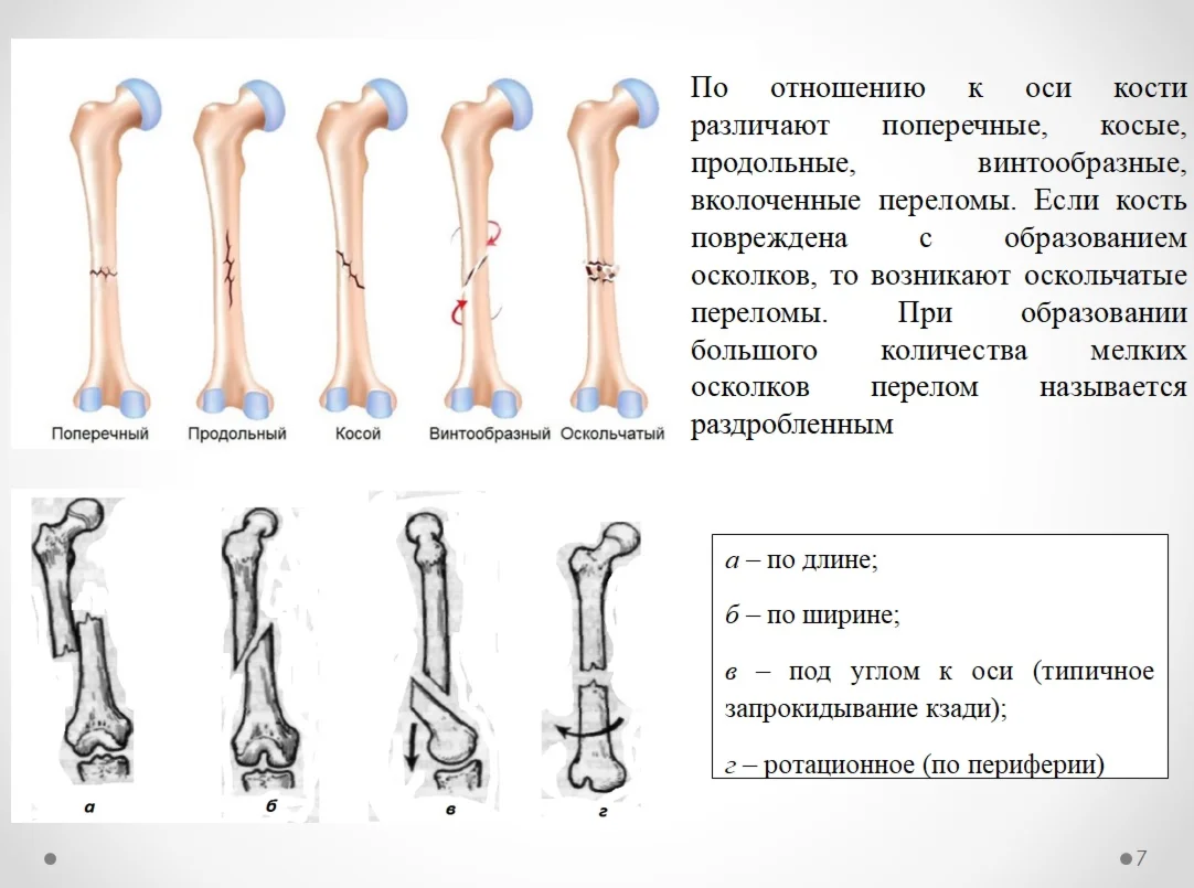 ДИПЛОМ СЕСТРИНСКИЙ УХОД ПРИ СКЕЛЕТНОМ ВЫТЯЖЕНИИ