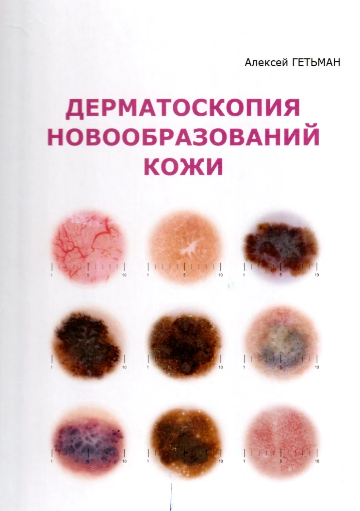 Дерматоскопия новообразований кожи. А.Д. Гетьман