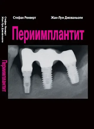 Периимплантит - Ренверт С., Джованьоли Ж-Л.