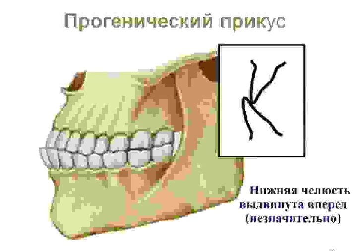 Bite options in humans