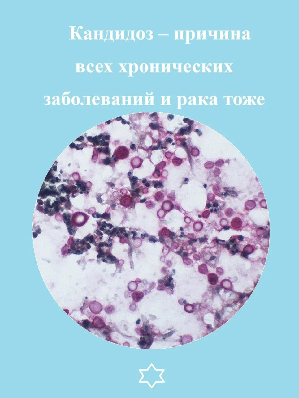 Candidiasis is the cause of all diseases and cancer